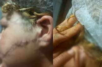 Suspeito teria desfigurado rosto da ex-esposa ao golpeá-la com uma faca