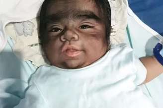 Condição é caracterizada pelo crescimento de pelos em todo o corpo