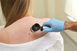 Terapia combinada mantém uma redução de 49% no melanoma após 5 anos