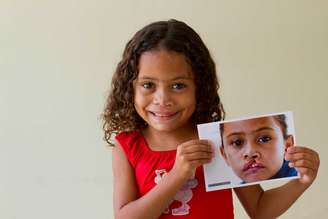 Dados da Organização Mundial da Saúde (OMS) mostram que uma em cada 650 crianças nasce com fissura lábio palatina no Brasil