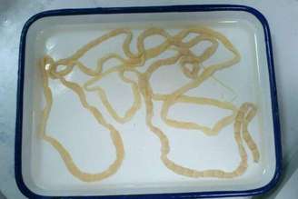 <p>O verme instalado no intestino da chinesa Li tinha 2 metros de comprimento</p>