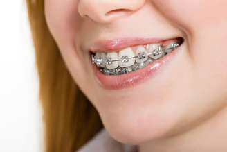 Essa combinação de desorganização do ligamento e seu alargamento causam a mobilidade dentária transitória, ou seja, sim os dentes ficam moles por um período!