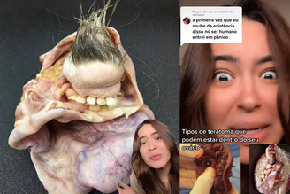 Influenciadora Drielly Arruda mostra teratoma em seu TikTok