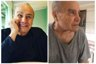 Stenio Garcia antes e dias após harmonização facial