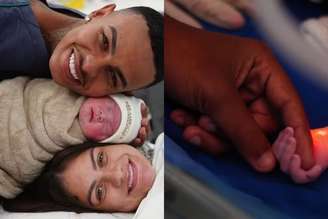 Bebê precisou remover dois dedos por orientação médica