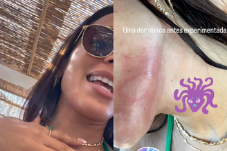 Anitta relata ter sofrido ataque de água-viva durante passeio em Ibiza