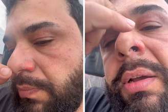 Léo Oliveira mostrou como ficou seu rosto após ser atingido por fogo em show