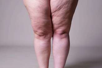 A prevalência estimada de lipedema na população feminina entre 18 e 69 anos é de 12,3%, o que representa cerca de 8 milhões de brasileiras