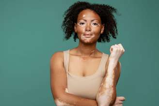 O vitiligo é uma doença autoimune que provoca a descoloração da pele