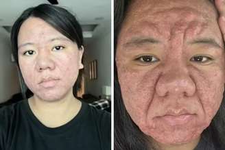 Farah afirma que problema de pele durante a gravidez afetou seu emocional