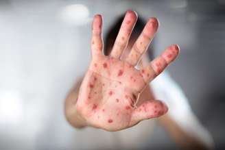 A doença mão-pé-boca (DMPB) é uma infecção viral comum em todo o mundo, causada principalmente pelo vírus Coxsackie A16