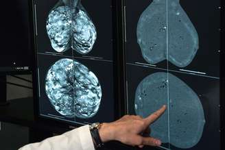 Mamografia passa a ser recomendada a partir dos 40 anos, diz Ministério da Saúde