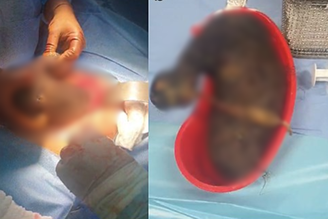 Adolescente diagnosticada com 'síndrome de Rapunzel' tem bola gigante de cabelo removida do estômago