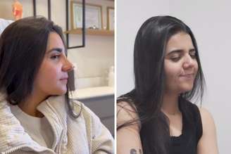 Cantora Yasmin Santos mostra resultado da cirurgia | Na foto: agora e antes