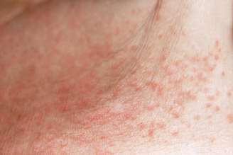 Câncer de pele: como identificar sinais suspeitos