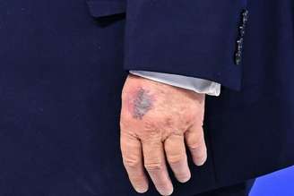 Hematomas pelo corpo de Trump têm sido vistos com frequência