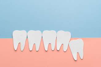 Nem sempre há espaço suficiente na boca para que os dentes do siso nasçam corretamente