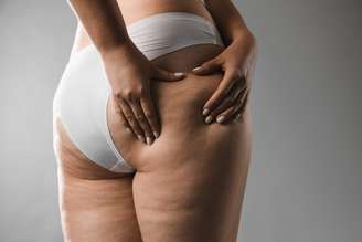 É lipedema ou retenção de líquido? Tire essa e outras dúvidas!