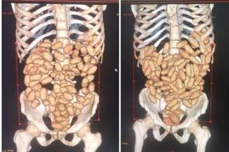 Raio-X mostra droga encontrada dentro de mula do tráfico