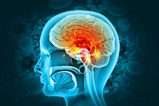 A meningite é a inflamação das meninges, causada por vírus, bactérias, fungos ou parasitas, que afeta cérebro e medula espinhal