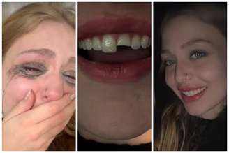 Eduarda Henkemeier viralizou ao quebrar dente em balada, ir ao dentista de madrugada e voltar para festa
