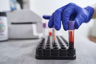 Exames de sangue podem prever o início dos sintomas de Alzheimer com anos de antecedência