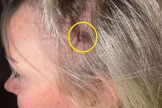 melanoma no couro cabeludo.