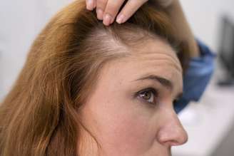 A queda de cabelo durante a menopausa é uma das questões que mais assusta as mulheres