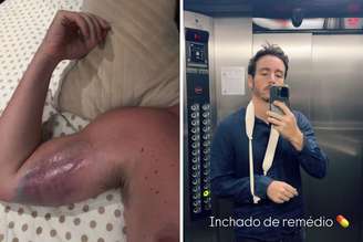 Wagner mostra hematoma após acidente em academia; ator mostra inchaço após tomar medicamento