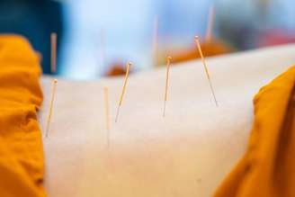 Veja como a acupuntura pode aliviar os efeitos da quimioterapia