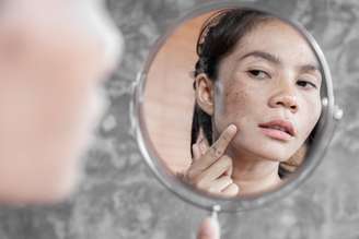 Saiba como o melasma age na pele