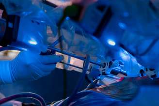 Cirurgia robótica é uma das técnicas utilizadas no tratamento do câncer renal e, em casos selecionados, permite a retirada do tumor com preservação de parte do rim