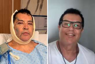Cantor Bebo Barbosa mostra resultado de procedimento estético após dois dias | Cantor Beto Barbosa antes da cirurgia