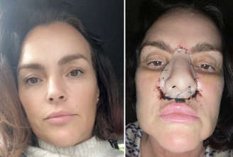 Lisa Mercer, 49, had to have her entire nose removed after cancer was discovered in her sinuses and the base of her skull. 