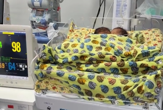 Bebês siameses nasceram em maio, em Goiânia 