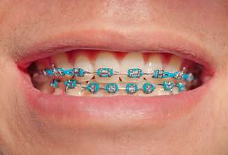 O papel das borrachinhas é segurar o arco ortodôntico aos braquetes, que são aqueles pequenos quadradinhos colados em cada dente