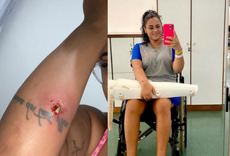 O furúnculo originou uma infecção bacteriana que deixou Jéssica paraplégica