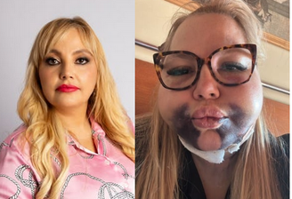 A advogada Eloah Lins ficou com o rosto deformado após o procedimento