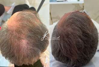 Dra. Maria Fernanda, especialista da JK Estética Avançada, explica sobre o tratamento da alopecia androgenética da Xuxa