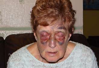 <p>Anne Heenan, de 74 anos, ficou gravemente ferida após tropeçar no meio-fio entre a rua e a calçada no centro de Grimsby, no Reino Unido</p>