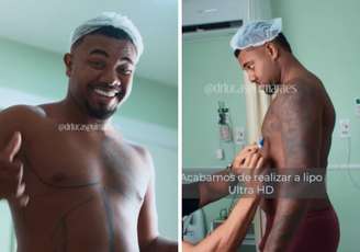Davi Brito mostra resultado de cirurgia estética