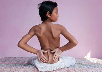 <p>Arshid Ali Khan, de 13 anos, terá que passar por uma cirurgia devido à anomalia. Ele não consegue andar</p>