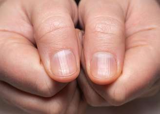 Alterações na pele e nas unhas podem indicar deficiência de vitaminas e minerais