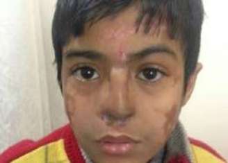 O nariz de Arun Patel ficou desfigurado após uma pneumonia