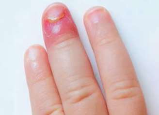 Inflamação ao redor das unhas: o unheiro é uma infecção comum que pode causar dor, vermelhidão e inchaço quando não tratada corretamente – Reprodução de Vídeo