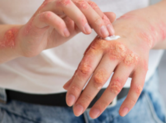 Brasil soma 88 casos confirmados em 2026, segundo o Ministério da Saúde