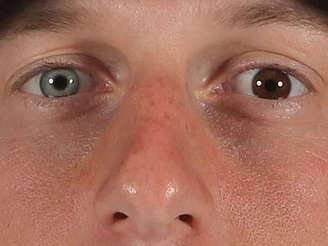 Max Scherzer, jogador norte-americano de basebol, tem uma grande diferença nas cores dos olhos
