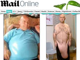 <p>Stephen Dockerill perdeu 82 kg com uma cirugia bariátrica, mas agora sofre com o excesso de pele de sua barriga</p>