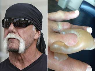 Ex-lutador Hulk Hogan queimou a mão com o radiador do carro