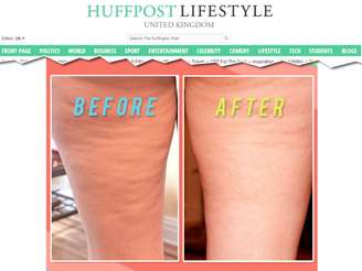 <p>O melhor resultado apareceu ao aplicar &oacute;leo de coco e massagear em seguida com &oacute;leo de banho. A foto mostra diferen&ccedil;a ap&oacute;s um m&ecirc;s de aplica&ccedil;&atilde;o</p>